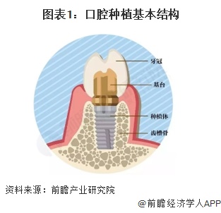 图表1：口腔种植基本结构